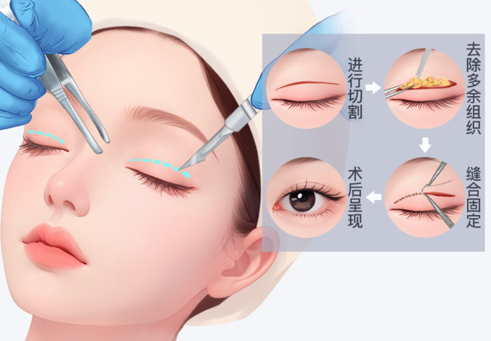 賀曼醫(yī)生雙眼皮全流程確保