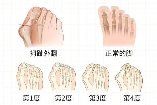 二、陳圣英拇外翻價格表收費參考：3大關(guān)鍵影響因素www.66ub.cn