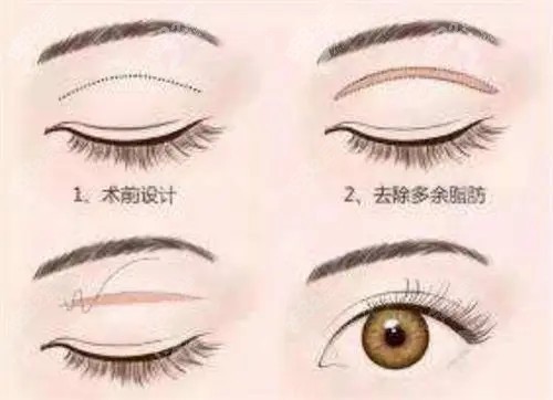 全切雙眼皮卡通示意圖