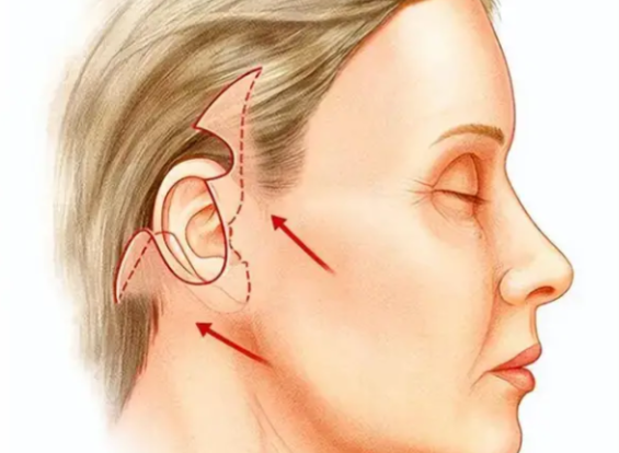 耳前韌帶提升價(jià)格避坑：這些問(wèn)題一定要注意