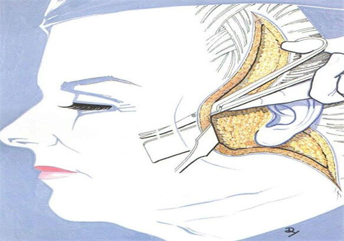 上海王洪內(nèi)窺鏡額頭提升多少錢大揭秘，微創(chuàng)技術(shù)、快速恢復(fù)，性價(jià)比一目了然！