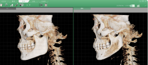 韓國345輪廓怎么樣？韓國345是正規(guī)的靠譜的，從真實手術思路、適合人群與效果深度評測