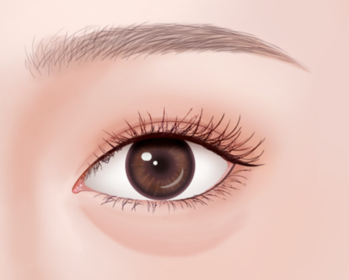 成都大華醫(yī)學(xué)美容去眼袋實(shí)例參考