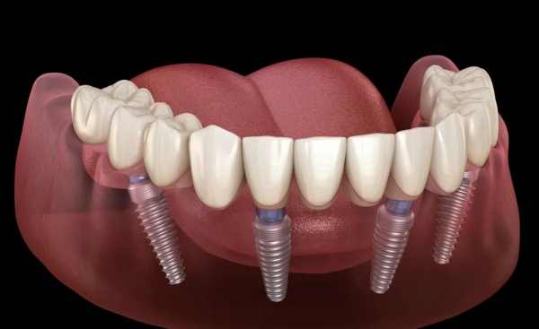 一、廣州種植牙醫(yī)院排名及特色清單