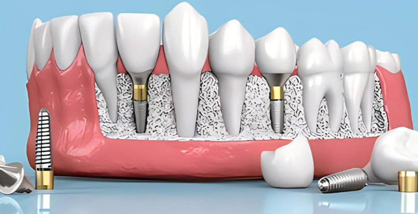三、廣州省口腔種植牙價格影響因素