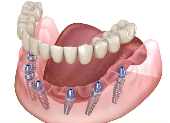 二、廣州省主要口腔醫(yī)院種植牙價格及特色