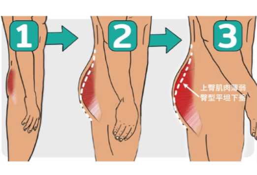 二、玻尿酸豐臀療效維持時間及影響因素