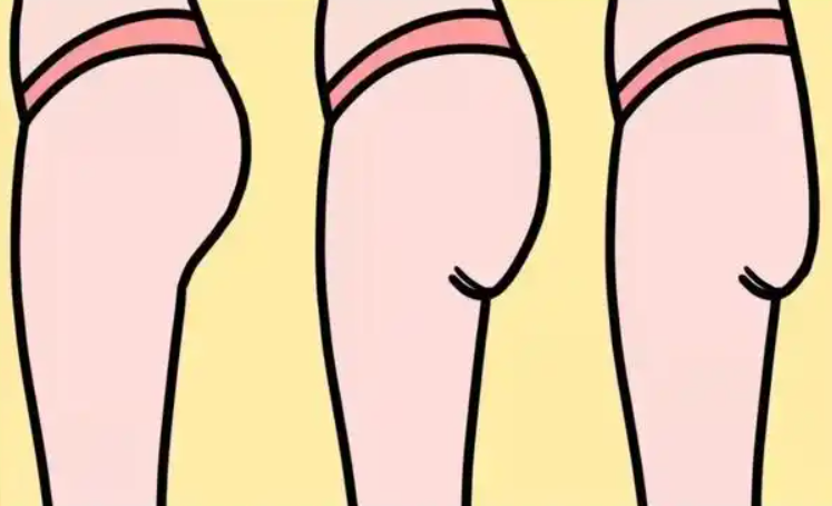 三、玻尿酸豐臀的風(fēng)險與并發(fā)癥www.66ub.cn