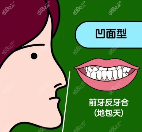 地包天漫畫示意圖