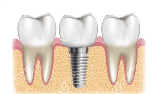 種植牙周?chē)】笛? title=