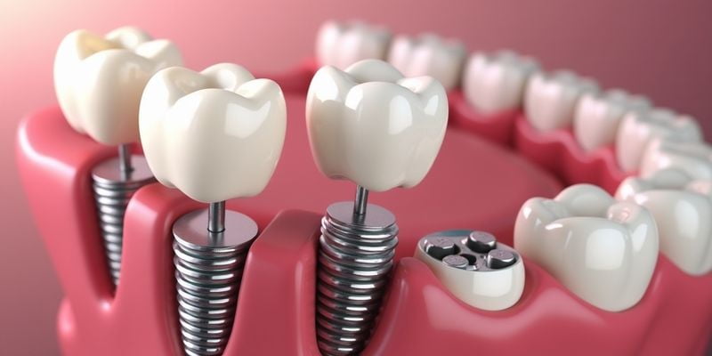 瑞士植體種植牙價(jià)格揭秘