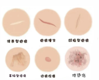 馬銳醫(yī)生疤痕切縫手術(shù)技術(shù)特點(diǎn)