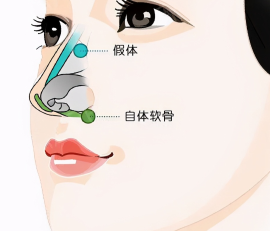 深圳張輝赫本鼻的優(yōu)勢及確保
