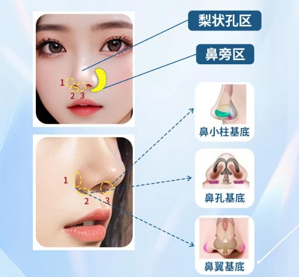 一、國(guó)內(nèi)哪里做鼻基底填充口碑好（五家有名醫(yī)院深度對(duì)比）