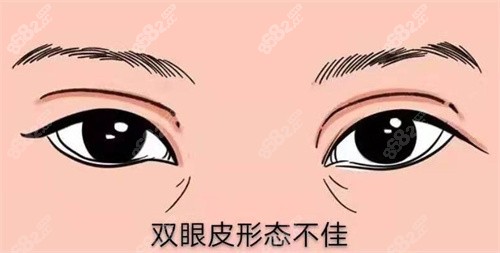 修復(fù)雙眼皮