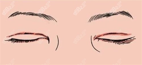 雙眼皮疤痕修復(fù)