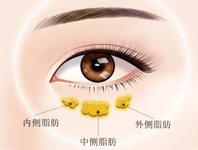 鄒俊峰醫(yī)生去眼袋的優(yōu)勢