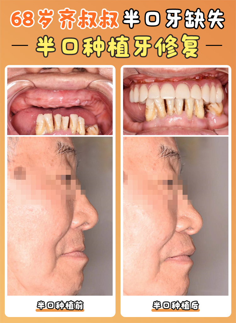 長春九臺區(qū)潔雅口腔醫(yī)院靠譜不？張醫(yī)生種牙超厲害