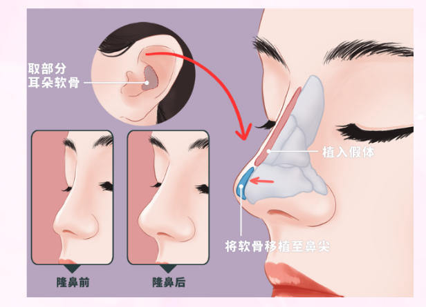 三、鄧裴醫(yī)生隆鼻手術(shù)就診全攻略