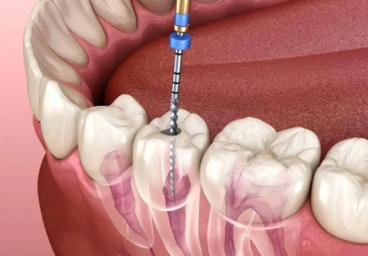 四、現(xiàn)代根管治療：數(shù)字化與生物材料