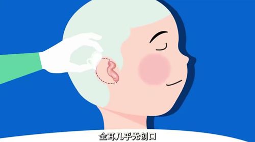董立維小耳再造年手術(shù)量超200臺的技術(shù)支撐