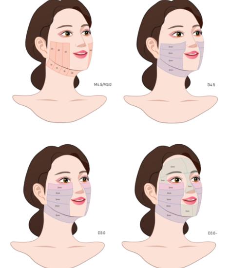 假拉皮是不是只縫合一層？揭秘手術(shù)層次差異