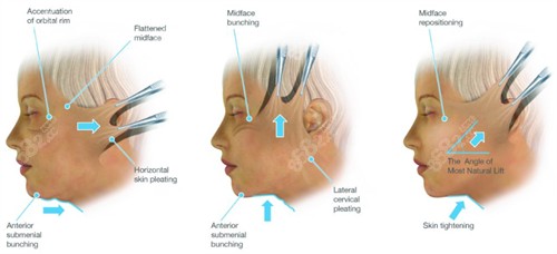 拉皮手術(shù)不同角度 拉皮手術(shù)不同角度