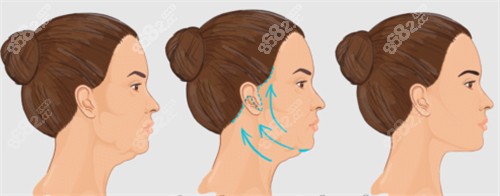 面部提升改善皮膚狀態(tài) 面部提升改善皮膚狀態(tài)