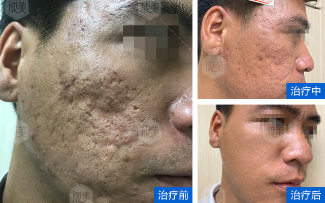 沈陽(yáng)華美疤痕醫(yī)院靠譜不？技術(shù)實(shí)力杠杠的