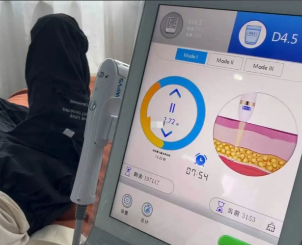 半島超聲炮和鉆石超聲炮療效時(shí)間軸