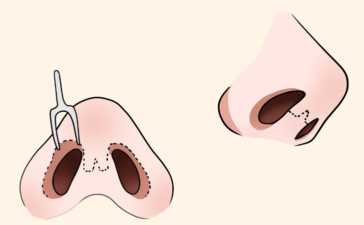 李長富醫(yī)生的鼻綜合手術怎么預約