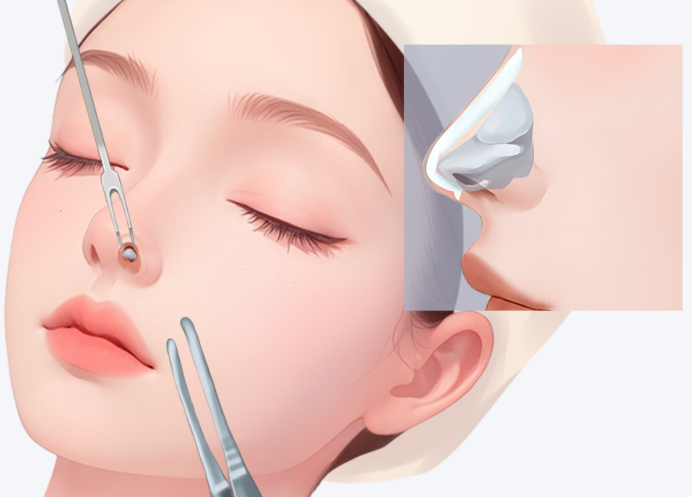 上海吳應(yīng)凱鼻整形的技術(shù)特點