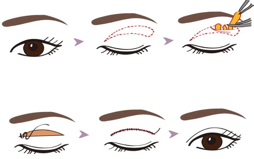 常見雙眼皮手術(shù)方式及維持時(shí)間