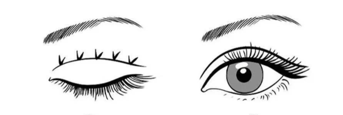 KISS法雙眼皮手術(shù)原理