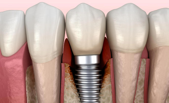 一、廣州種植牙正規(guī)醫(yī)院排名清單