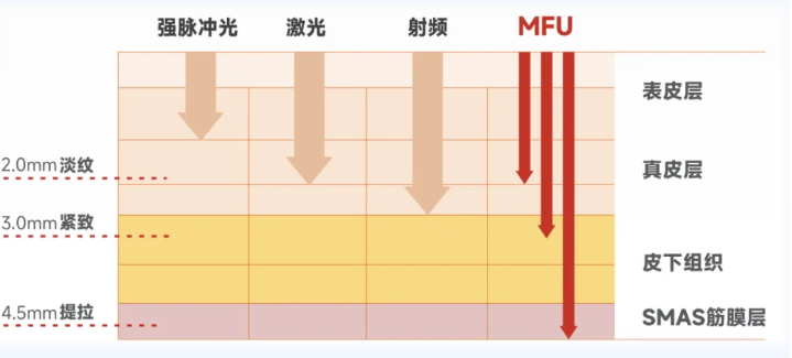 超聲炮項(xiàng)目的優(yōu)勢與特點(diǎn)