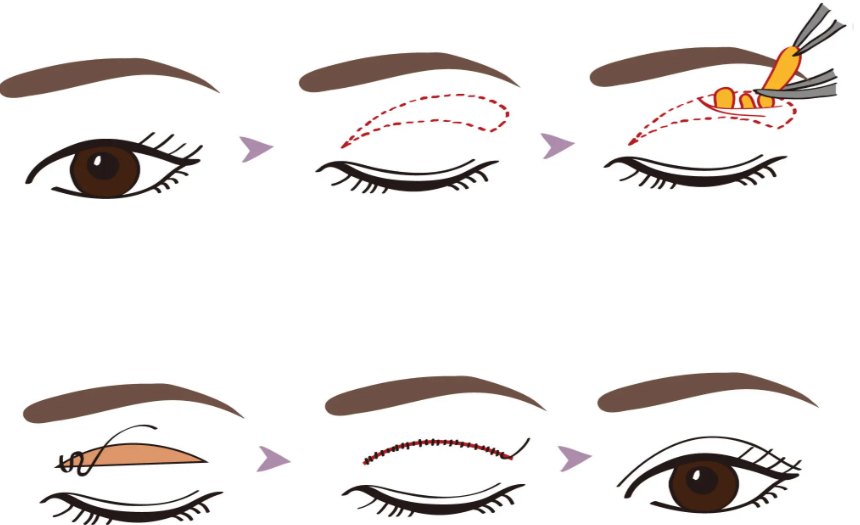 鄭州李朋杰雙眼皮手術(shù)技術(shù)因素