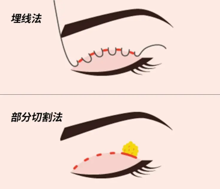 鄭州李朋杰雙眼皮手術(shù)價格價格