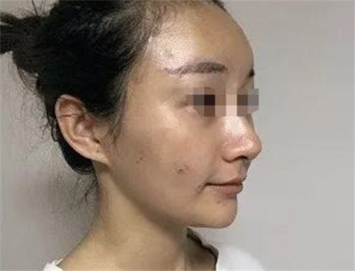 少女針伊妍仕多少錢一針？北京畫美張瀟瀟/高明英注射，效果自然持久