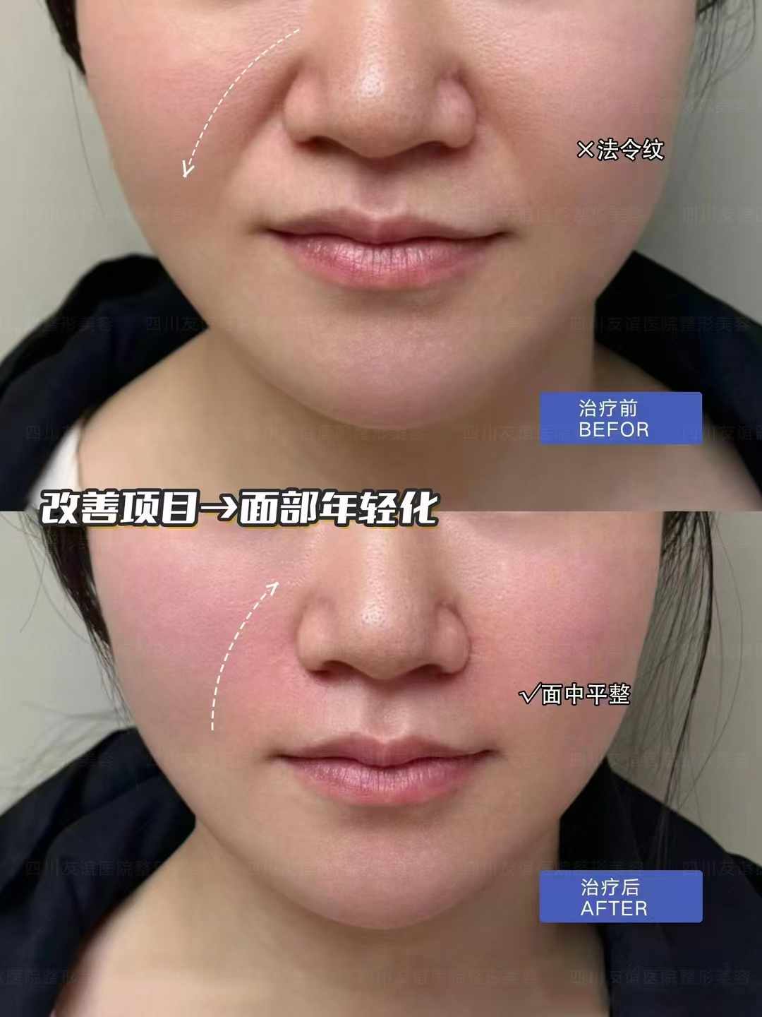 穆寶安v6手術(shù)：適合的人群和成效維持時間www.sorencai.cn