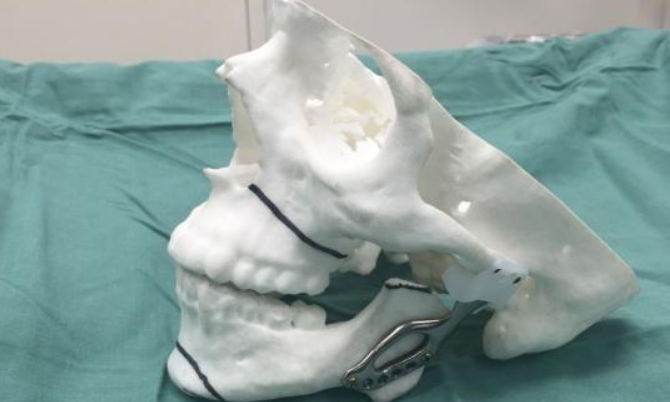 二、PEEK下巴價(jià)格差異的關(guān)鍵影響因素