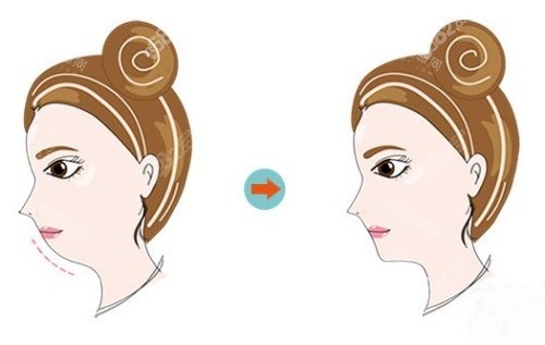 正頜前后示意圖