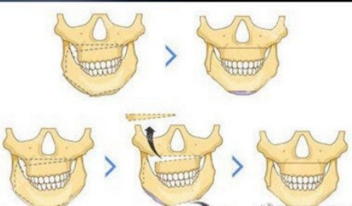 正頜流程示意圖