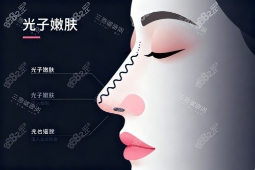 面部做光子嫩膚卡通圖