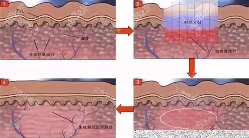 光子嫩膚的步驟