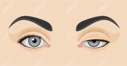 雙眼皮修復(fù)前后對比