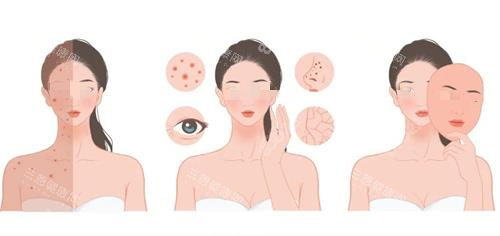 光子嫩膚治療前后對比圖