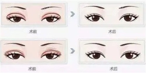 雙眼皮修復(fù)