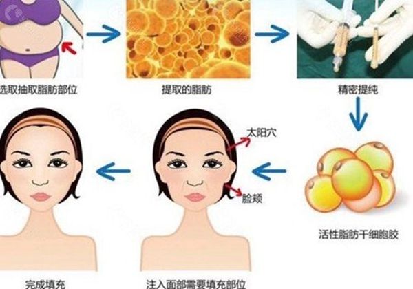 選沈陽(yáng)自體脂肪填充醫(yī)院