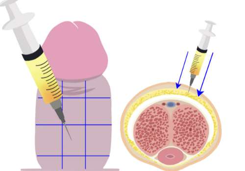 六、李世榮延長增粗術(shù)后變好較快嗎？會影響生活嗎？